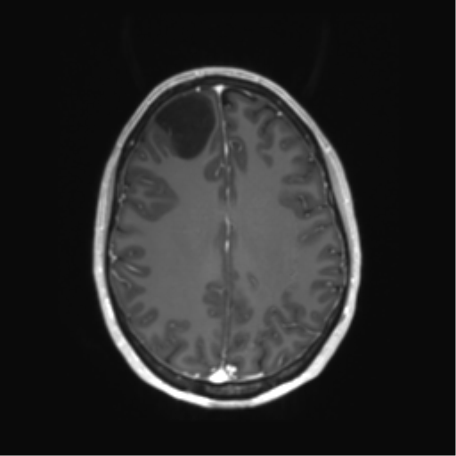 File:Astrocytoma, IDH-mutant - grade 3 (Radiopaedia 50046-55341 Axial 203).png