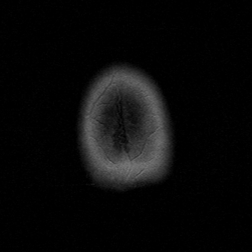 File:Astrocytoma - WHO grade II (Radiopaedia 16279-15959 Axial T1 C+ 1).jpg