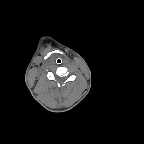 File:Atlanto-occipital dissociation (Traynelis type 1), C2 teardrop fracture, C6-7 facet joint dislocation (Radiopaedia 87655-104061 Axial non-contrast 47).jpg