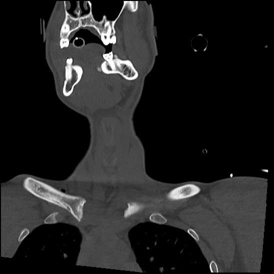Atlanto-occipital dissociation (Traynelis type 1), C2 teardrop fracture, C6-7 facet joint dislocation (Radiopaedia 87655-104061 Coronal bone window 13).jpg