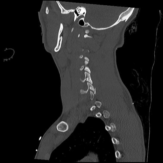 Atlanto-occipital dissociation (Traynelis type 1), C2 teardrop fracture, C6-7 facet joint dislocation (Radiopaedia 87655-104061 Sagittal bone window 51).jpg