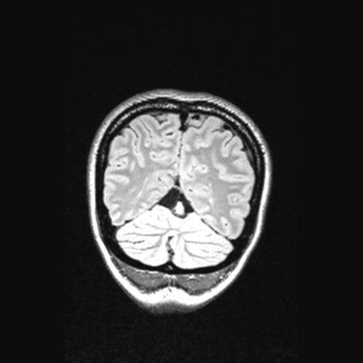Atretic encephalocoele with inferior vermis hypoplasia (Radiopaedia 30443-31108 Coronal FLAIR 39).jpg