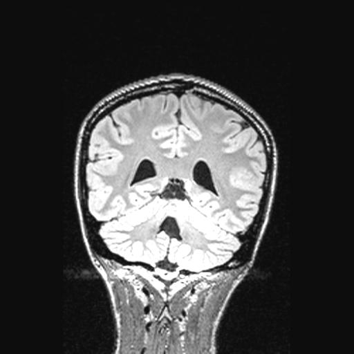 Atretic encephalocoele with inferior vermis hypoplasia (Radiopaedia 30443-31108 Coronal FLAIR 64).jpg