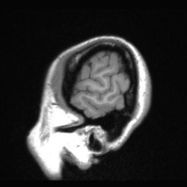 File:Atretic encephalocoele with inferior vermis hypoplasia (Radiopaedia 30443-31108 Sagittal T1 124).jpg