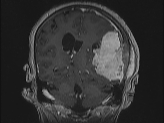 File:Atypical meningioma (Radiopaedia 62985-71406 Coronal T1 C+ 76).jpg