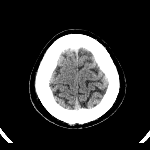 File:Atypical meningioma (WHO grade II) with brain invasion (Radiopaedia 57767-64728 Axial non-contrast 41).png