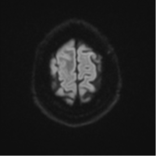 Atypical meningioma (WHO grade II) with brain invasion (Radiopaedia 57767-64729 Axial DWI 57).png