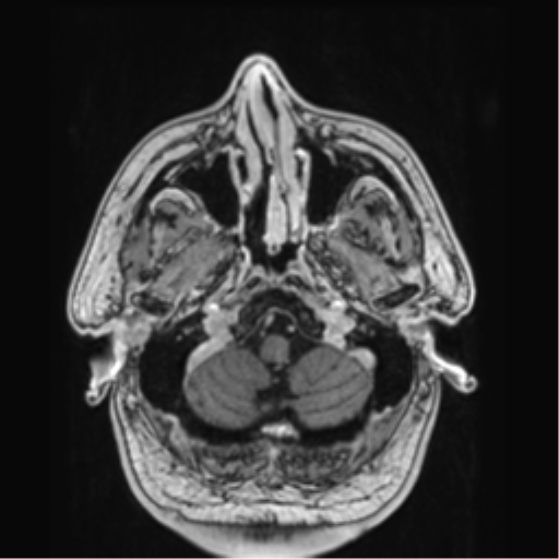File:Atypical meningioma (WHO grade II) with brain invasion (Radiopaedia 57767-64729 Axial T1 C+ 5).png