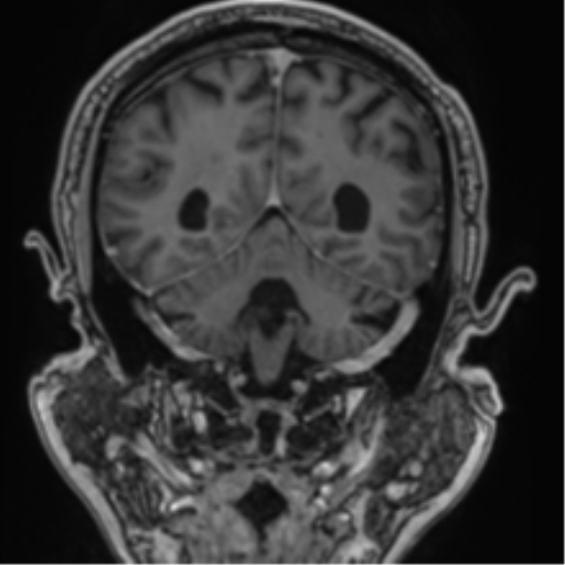 File:Atypical meningioma (WHO grade II) with brain invasion (Radiopaedia 57767-64729 Coronal T1 C+ 59).png