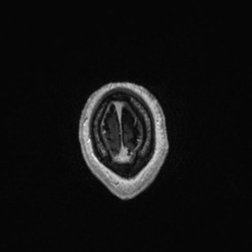 Atypical meningioma (grade II) - en plaque (Radiopaedia 29633-30147 Axial T1 C+ 168).jpg