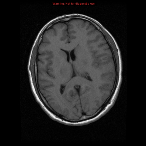 File:Atypical meningioma - grade II (Radiopaedia 13303-13305 Axial T1 12).jpg