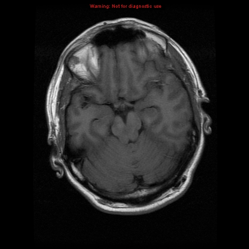 File:Atypical meningioma - grade II (Radiopaedia 13303-13305 Axial T1 8).jpg