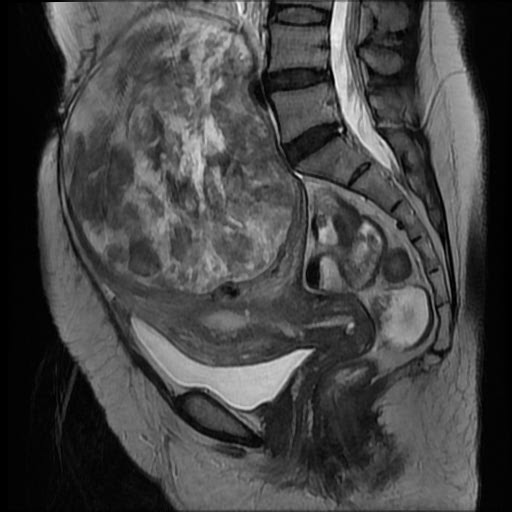 File:Atypical retroperitoneal lymphocoeles with large leiomyoma of uterus (Radiopaedia 32084-33027 Sagittal T2 16).jpg