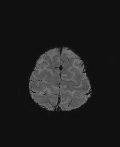 File:Autoimmune limbic encephalitis (Radiopaedia 30363-31005 SWI - mIP 63).jpg