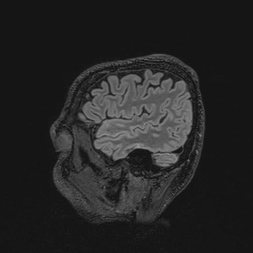 Autoimmune limbic encephalitis (Radiopaedia 30363-31005 Sagittal FLAIR 34).jpg