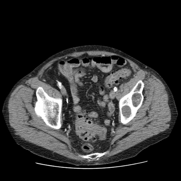 Autosomal dominant polycystic kidney disease (Radiopaedia 27851-28094 B 108).jpg