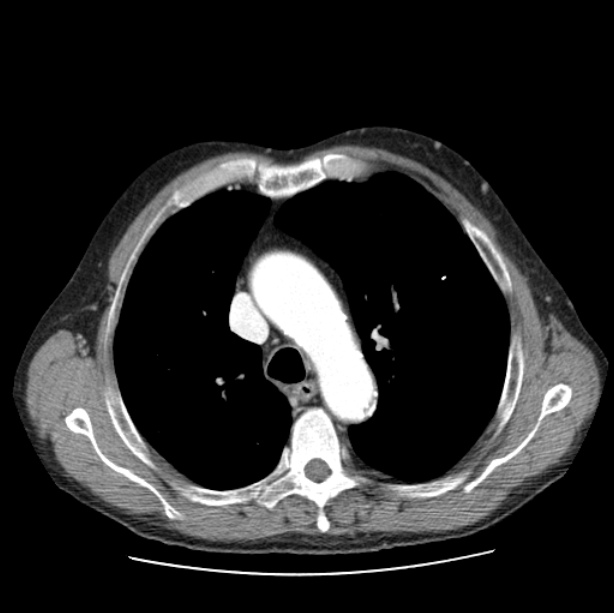 Autosomal dominant polycystic kidney disease (Radiopaedia 27851-28094 B 20).jpg