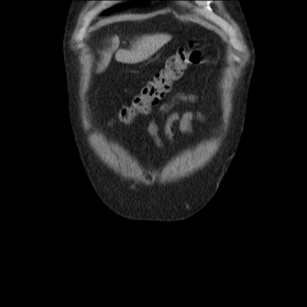File:Autosomal dominant polycystic kidney disease (Radiopaedia 36539-38101 C 9).jpg