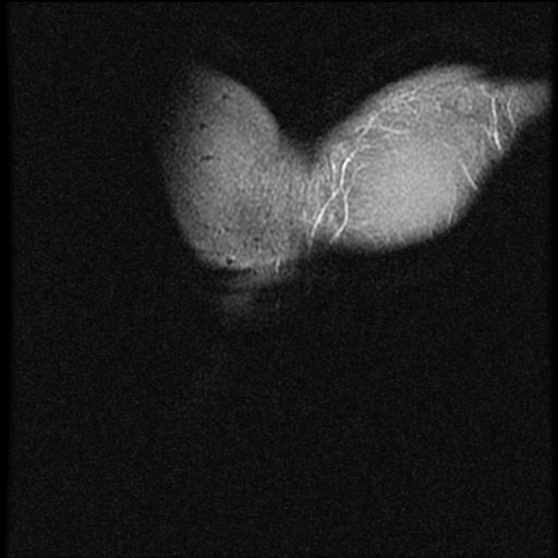 File:Avascular necrosis - scaphoid non-union (Radiopaedia 63457-72065 Coronal STIR 1).jpg