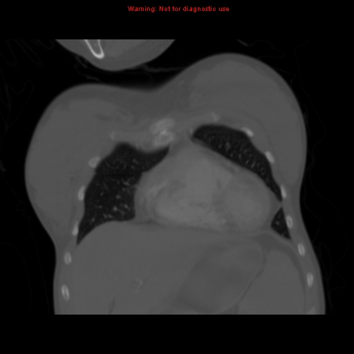 Avascular necrosis in sickle cell disease (Radiopaedia 17448-17152 Coronal bone window 27).jpg