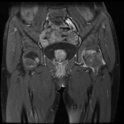 File:Avascular necrosis of the hip (Radiopaedia 29563-30067 I 6).jpg