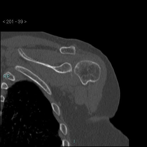 Avascular necrosis of the shoulder - Cruess stage I (Radiopaedia 77674-89887 Coronal bone window 38).jpg
