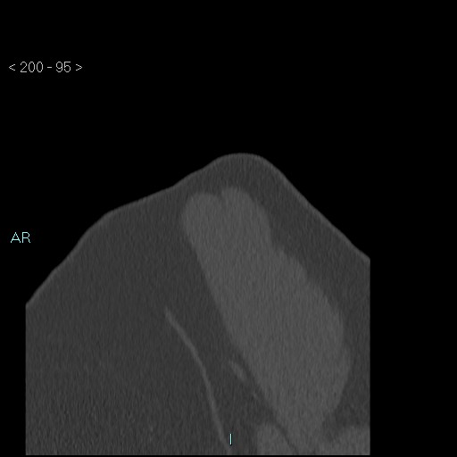 Avascular necrosis of the shoulder - Cruess stage I (Radiopaedia 77674-89887 Sagittal bone window 94).jpg