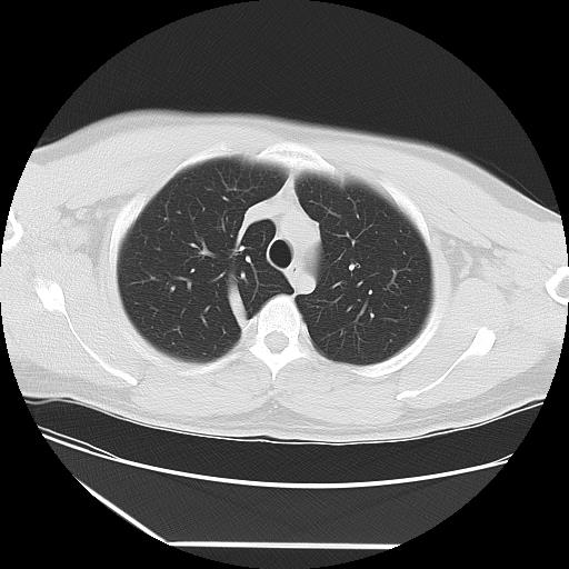 Azygos fissure (Radiopaedia 88181-104784 Axial lung window 11).jpg