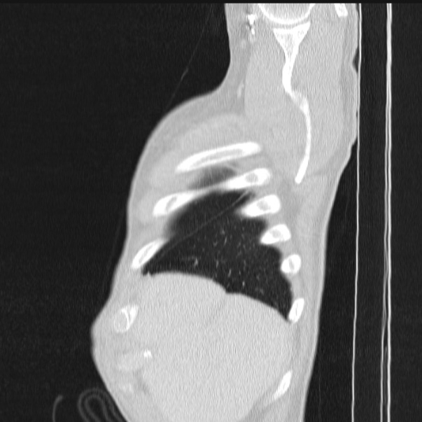 Azygos lobe (Radiopaedia 38259-40275 lung window 12).jpg