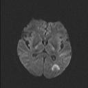 File:Balo concentric sclerosis (Radiopaedia 50458-55940 Axial DWI 57).jpg