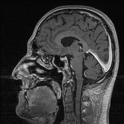 File:Balo concentric sclerosis (Radiopaedia 50458-55940 Sagittal T1 C+ 81).jpg