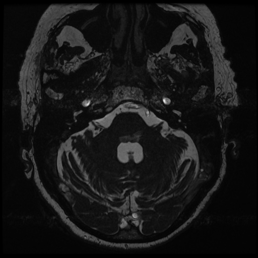 File:Balo concentric sclerosis (Radiopaedia 53875-59982 Axial T2 FIESTA 29).jpg