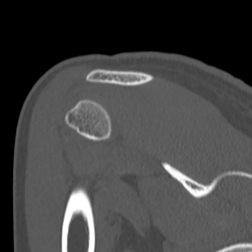 Bankart lesion (Radiopaedia 57256-64185 Coronal bone window 36).jpg