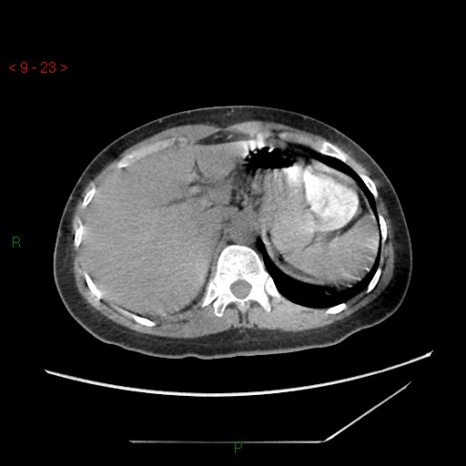File:Bartholin gland cyst (Radiopaedia 54904-61181 Axial C+ delayed 6).jpg