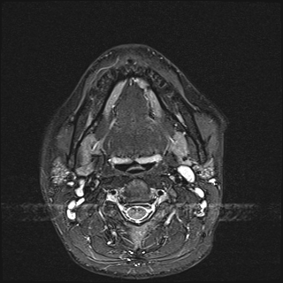 File:Basal cell carcinoma - nasal region (Radiopaedia 70292-80365 Axial STIR 27).jpg