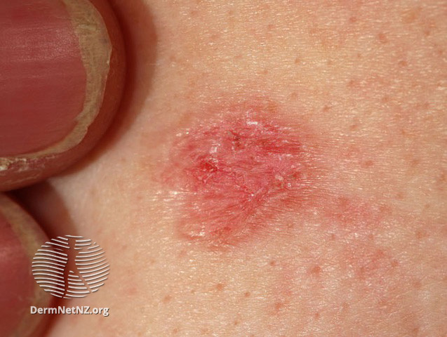File:Basal cell carcinoma affecting the trunk (DermNet NZ lesions-bcc-trunk-0663).jpg