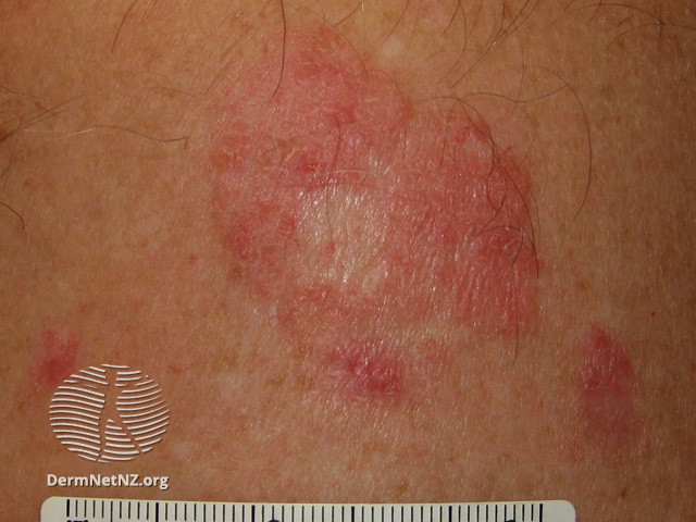 File:Basal cell carcinoma affecting the trunk (DermNet NZ lesions-bcc-trunk-0689).jpg