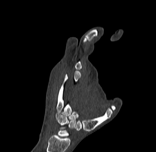 Base of 2nd metacarpal fracture (Radiopaedia 73741-84544 Coronal bone window 53).jpg
