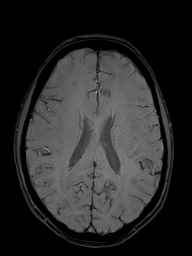 Basilar artery perforator aneurysm (Radiopaedia 82455-97733 Axial SWI 37).jpg