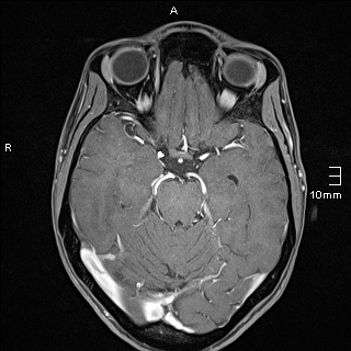Basilar artery perforator aneurysm (Radiopaedia 82455-99523 G 52).jpg