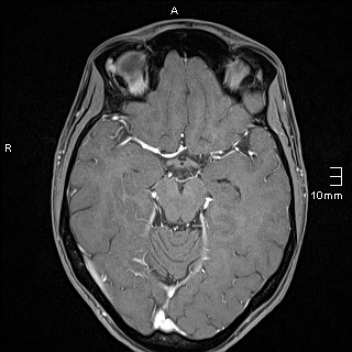 Basilar artery perforator aneurysm (Radiopaedia 82455-99523 G 58).jpg
