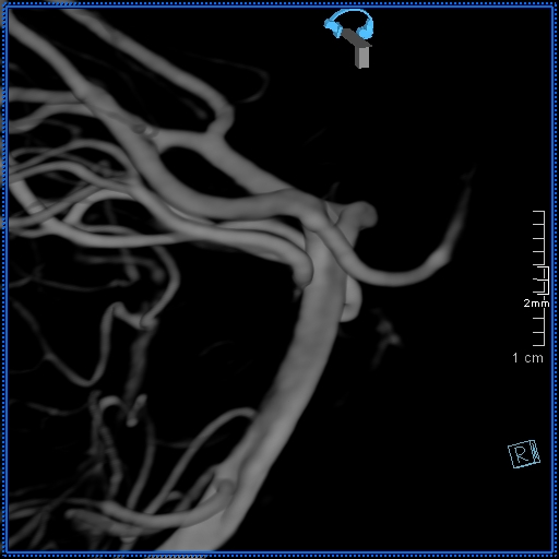 Basilar artery perforator aneurysm (Radiopaedia 82455-99524 3D Left VA 62).jpg