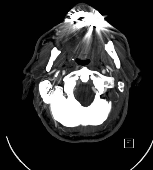 Basilar artery thrombosis (Radiopaedia 26986-27163 A 8).jpg