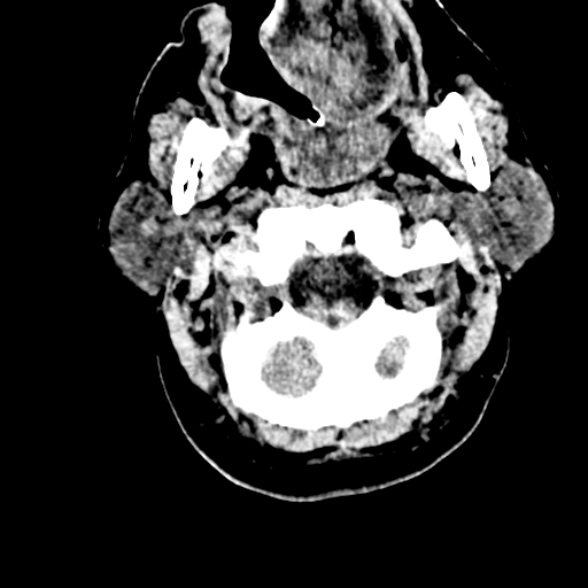 Basilar artery thrombosis (Radiopaedia 53351-59352 Axial non-contrast 13).jpg