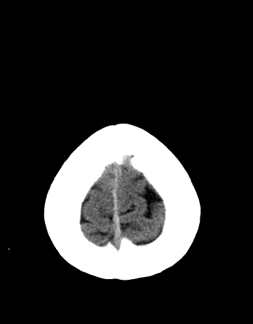 File:Basilar tip aneurysm with coiling (Radiopaedia 53912-60033 Axial 22).jpg