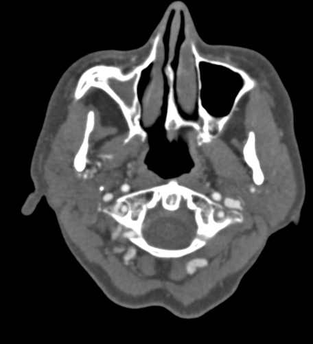 File:Basilar tip aneurysm with coiling (Radiopaedia 53912-60086 A 7).jpg