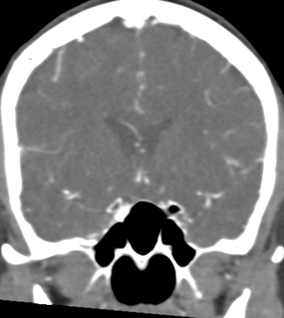Basilar tip aneurysm with coiling (Radiopaedia 53912-60086 B 55).jpg