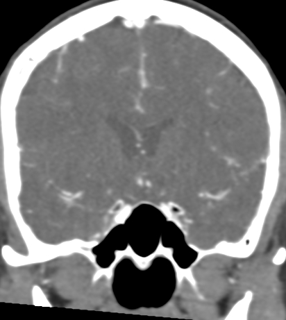 File:Basilar tip aneurysm with coiling (Radiopaedia 53912-60086 B 56).jpg