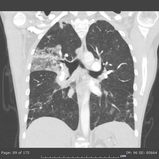 Behçet disease (Radiopaedia 44247-47889 Coronal lung window 26).jpg