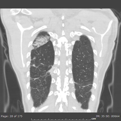 Behçet disease (Radiopaedia 44247-47889 Coronal lung window 4).jpg
